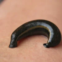 Atherosclerosis-and-leech-therapy-can-leeches-help-treat-atherosclerosis