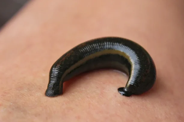 Atherosclerosis-and-leech-therapy-can-leeches-help-treat-atherosclerosis